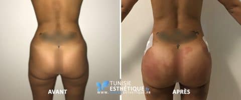 Injection De Graisse Au Fessier Lipofilling Des Fesses En Tunisie