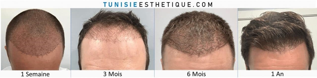 Greffe de cheveux - photos et prix - tunisie esthetique