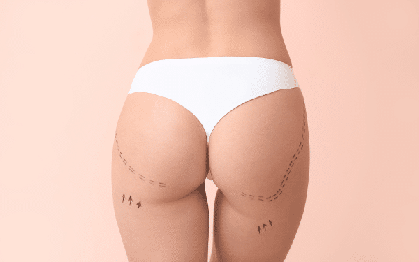 Le Brazilian Butt Lift (BBL) : tout ce que vous devez savoir